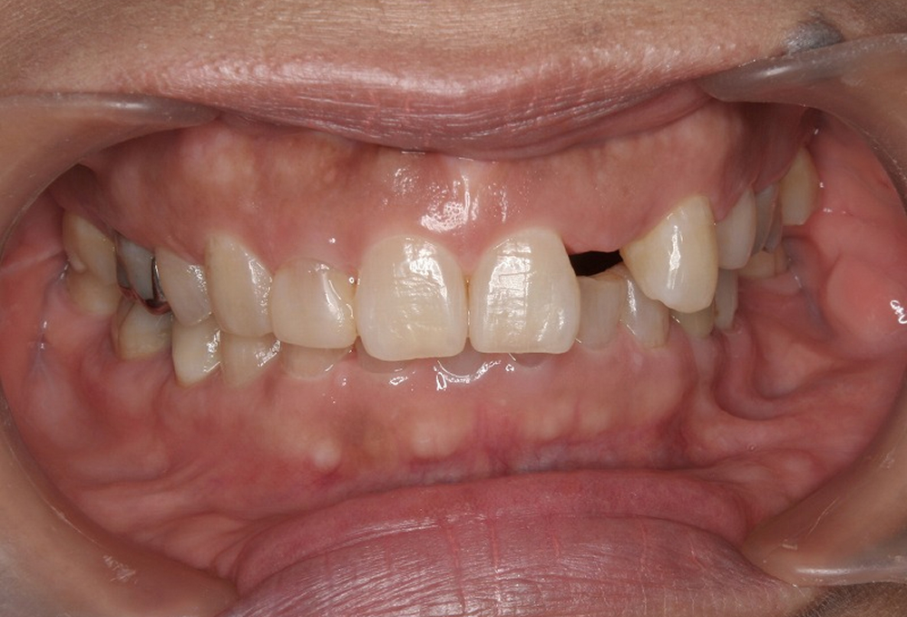 ⑤矯正後 インプラントのスペース確保