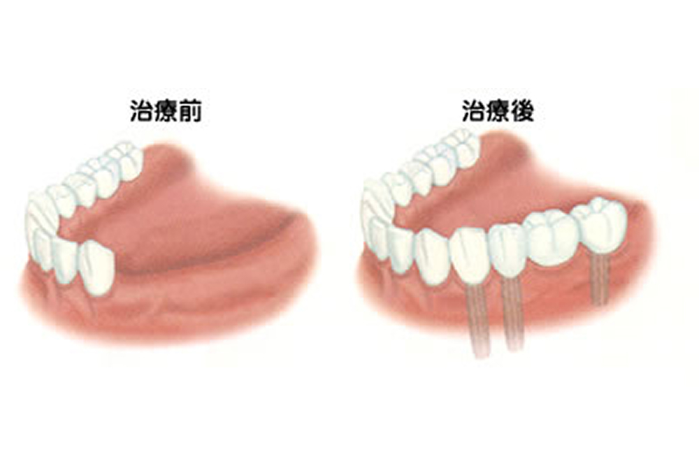 インプラントの治療例