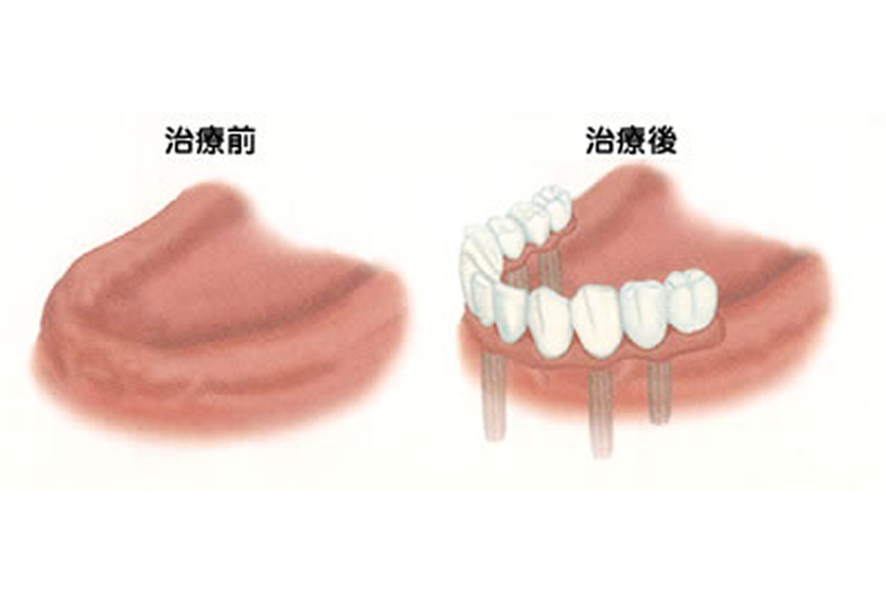 インプラントの治療例