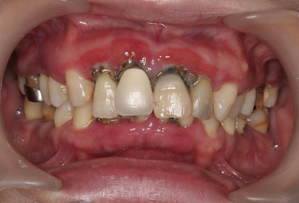 ①術前　プラークコントロール不良　歯周炎
                    