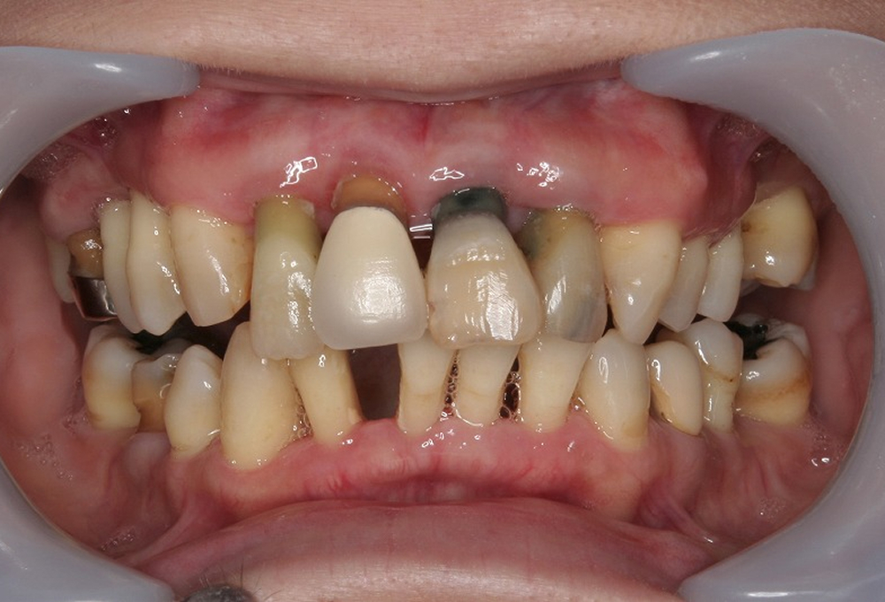 ⑤初期治療終了後
                    