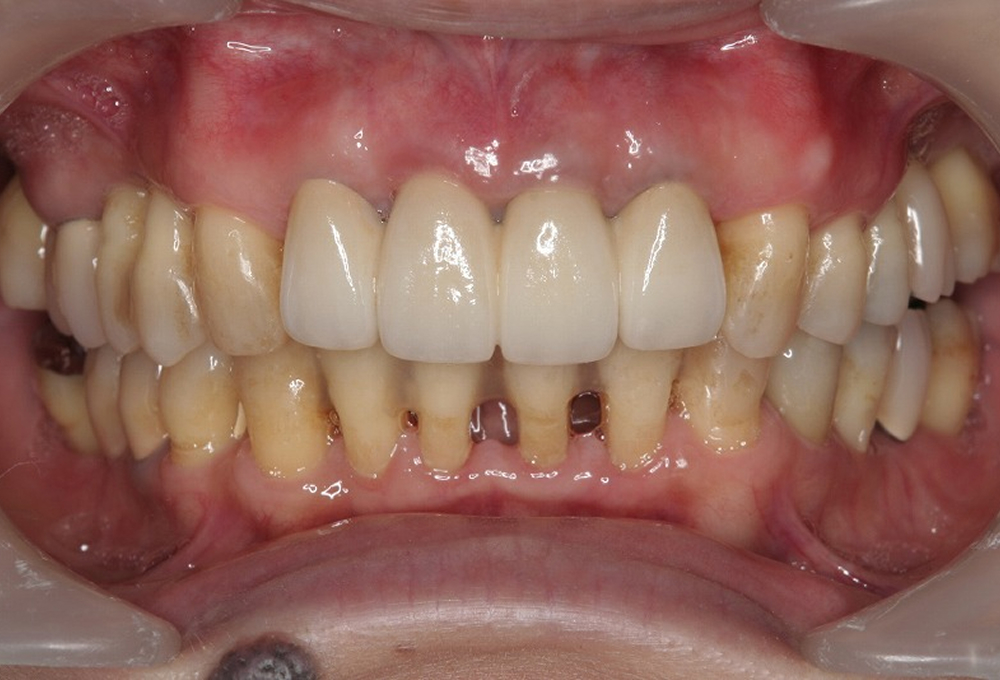 ⑨術後オールセラミック装着
                    