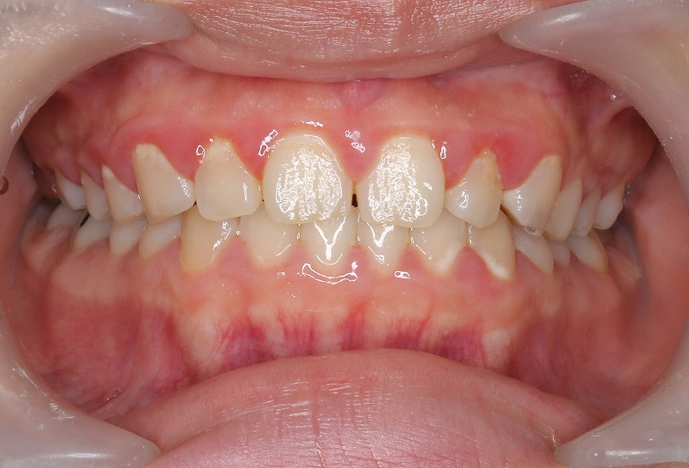 ①術前　プラークコントロール不良のため歯肉炎
                    